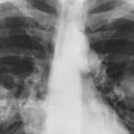 Radiografia de tórax em preto e branco com os dois pulmões e áreas mais claras que podem indicar câncer de pulmão, segundo a descrição do Instituto Nacional do Câncer dos EUA (imagem de arquivo, sem relação com os participantes do estudo)