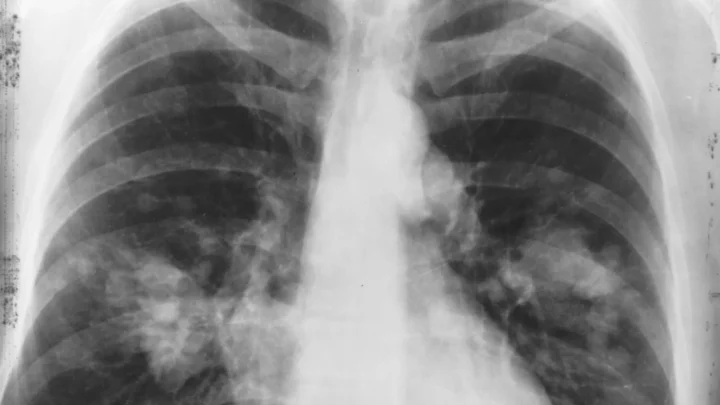 Radiografia de tórax em preto e branco com os dois pulmões e áreas mais claras que podem indicar câncer de pulmão, segundo a descrição do Instituto Nacional do Câncer dos EUA (imagem de arquivo, sem relação com os participantes do estudo)